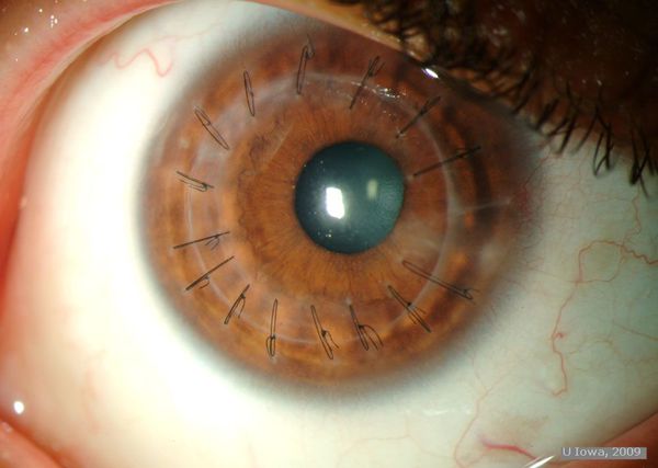 Глаз после пересадки роговицы
