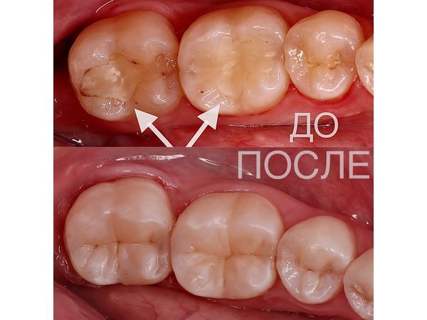 Глубокий кариес под пломбой: случай успешного лечения под контролем микроскопа