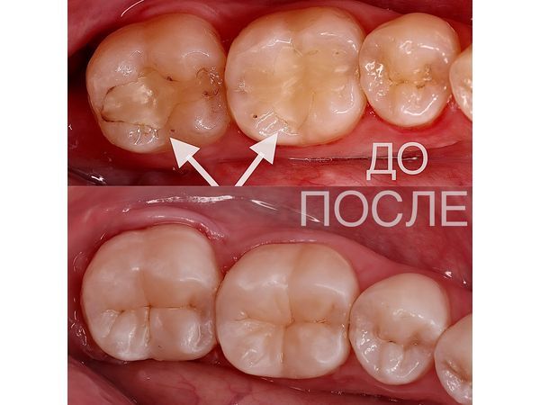 Нижние жевательные зубы до и после лечения