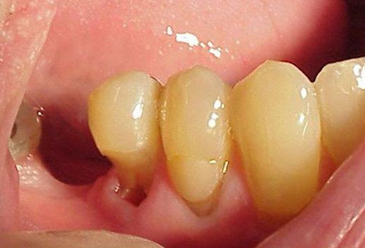 Глубокий кариес, который может привести к перелому зуба