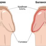 https://dgp1nn.ru/blog/wp-content/uploads/golovka-i-kraynyaya-plot-norma-i-vospalenie-s.jpg