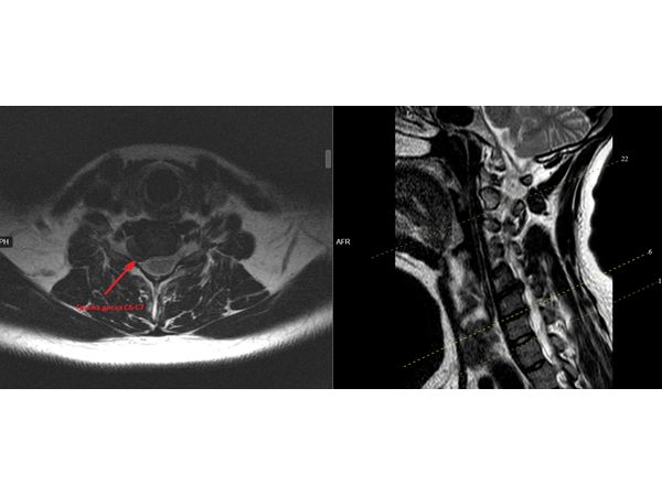 Грыжа и хроническая боль в шее: случай успешного лечения без операции