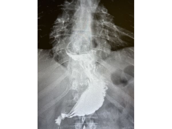 Рентгеноскопия с барием до операции. Прямая проекция