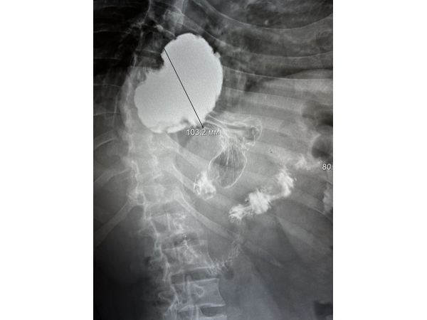 Рентгеноскопия до операции в положении лёжа на левом боку