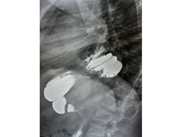 Рентгеноскопия до операции в положении лёжа на правом боку