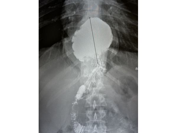 Рентгеноскопия до операции в положении лёжа: грыжа пищеводного отверстия диафрагмы размером до 12 см