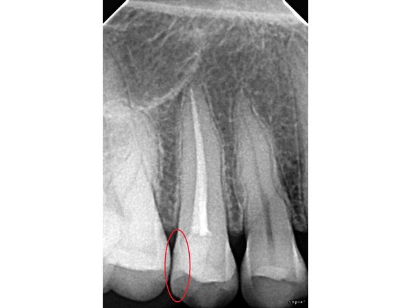 Идеальное краевое прилегание пломбы к стенкам зуба