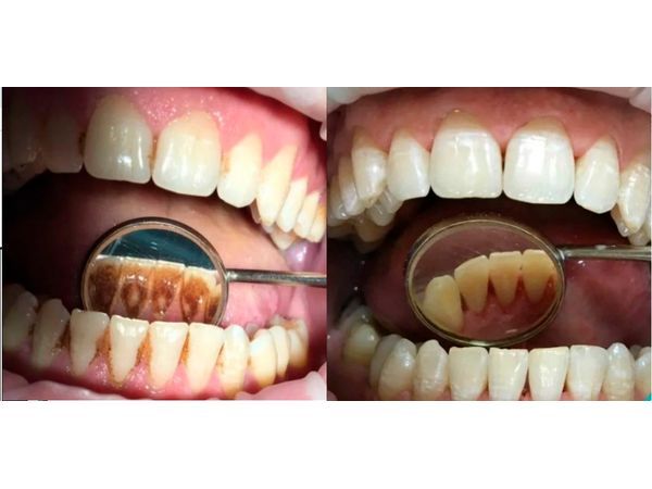 Зубы до и после профессиональной гигиены полости рта