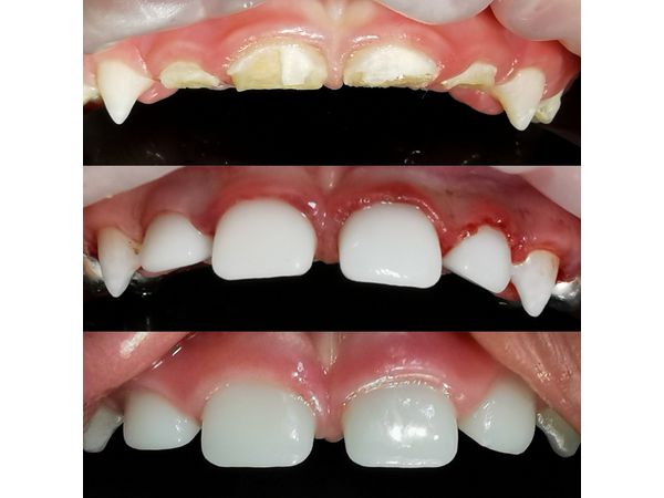 Верхние зубы до лечения, сразу после процедуры и спустя год