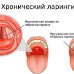 https://dgp1nn.ru/blog/wp-content/uploads/hronicheskiy-laringit-s.jpeg
