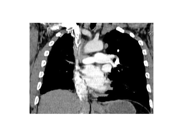 КТ грудной клетки: окклюзия правой лёгочной артерии