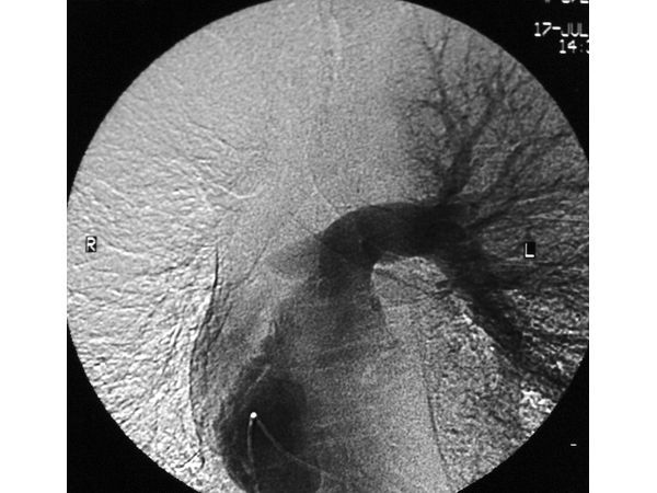Ангиопульмонография: окклюзия правой лёгочной артерии