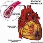https://dgp1nn.ru/blog/wp-content/uploads/infarkt-miokarda-s-1.jpg