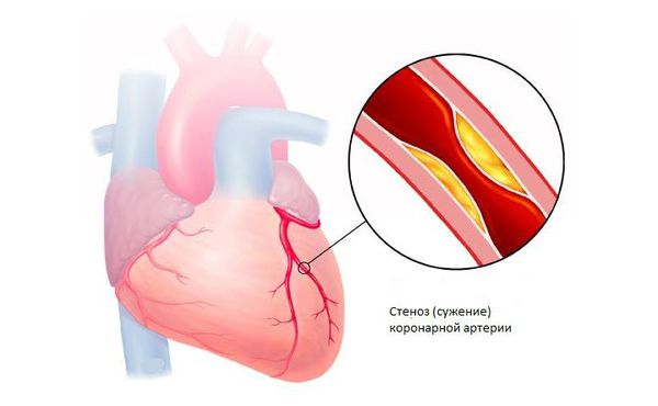Ишемическая болезнь сердца: сужение коронарной артерии
