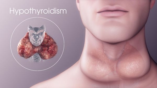 Изменение щитовидной железы при гипотиреозе