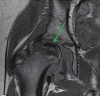 Изображение МРТ правого тазобедренного сустава у девятилетней девочки с болезнью Пертеса: низкий сигнал (зелёная стрелка), который свидетельствует о некрозе ' data-blur='False
