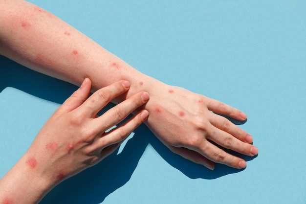 Симптомы и причины дерматита на руках