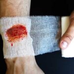 Как узнать, есть ли внутреннее кровотечение? Основные симптомы и признаки