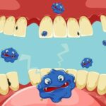 Камни на зубах: причины, симптомы и методы удаления