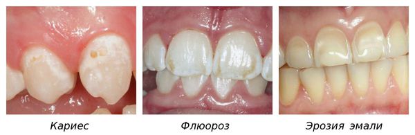 Кариес, флюороз и эрозия зубов, похожие на гипоплазию эмали