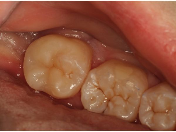 Зуб после лечения