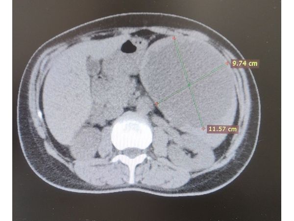 Компьютерная томография брюшной полости