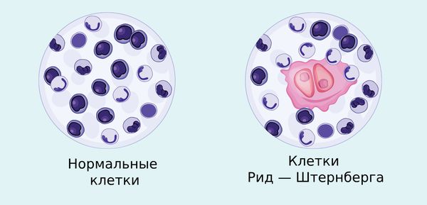 Клетки лимфомы