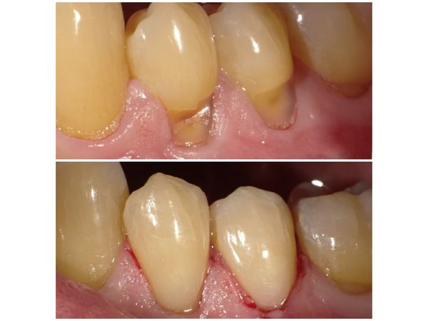 Зубы 3.4 и 3.5 до и после лечения