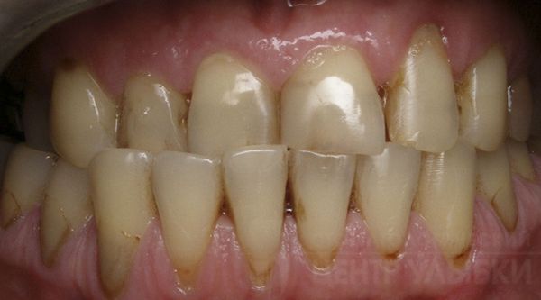 Клиновидные дефекты, сколы эмали и стираемость зубов при перекрёстном прикусе