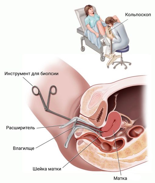 Кольпоскопия и биопсия шейки матки