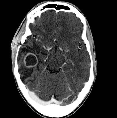 Компьютерная томограмма (аксиальный срез) пациента с контактным абсцессом базальных отделов правой височной доли головного мозга