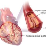 https://dgp1nn.ru/blog/wp-content/uploads/koronarnye-arterii-pri-ateroskleroze-s.jpg