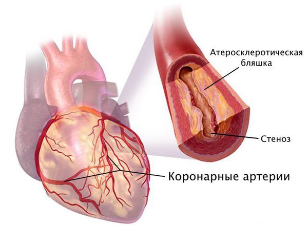 Коронарные артерии при атеросклерозе