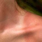 Кожная сыпь около ануса: причины, симптомы и лечение