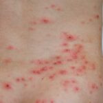 Красные точки на коже: причины, симптомы и методы лечения