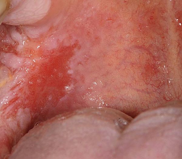 Красное пятно в полости рта при эритроплакии 