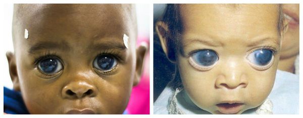 "Кукольные глаза" у детей с врождённой глаукомой