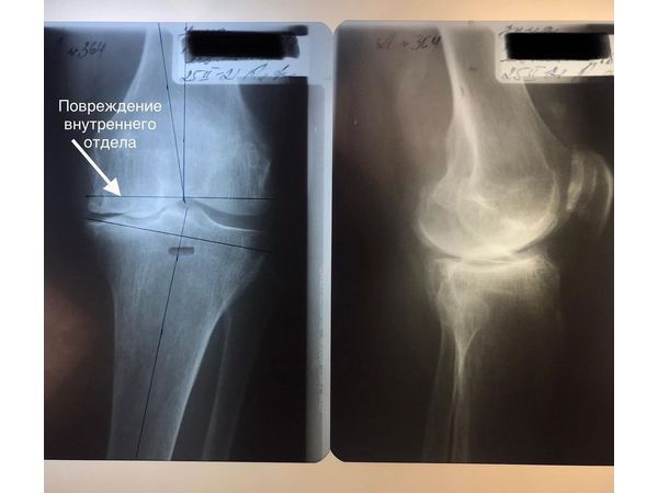 Рентгенограмма повреждённого сустава