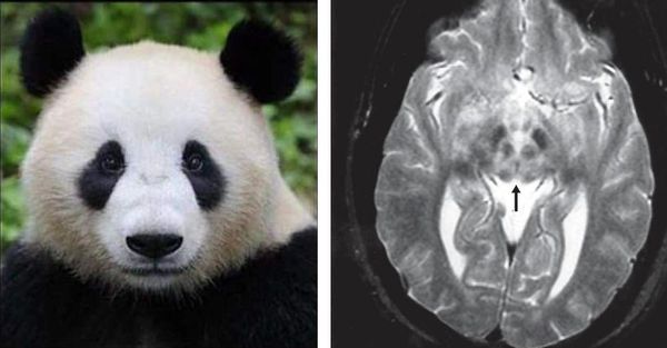 "Лицо гигантской панды" при болезни Вильсона — Коновалова