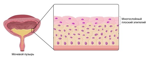 Лейкоплакия мочевого пузыря