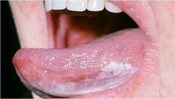 Лейкоплакия полости рта 
