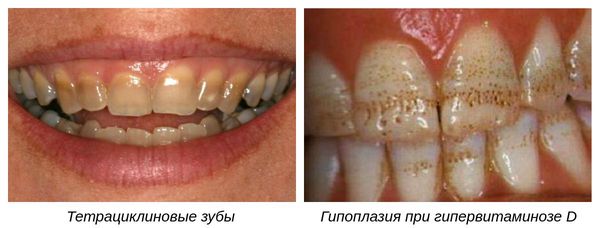 Медикаментозные виды гипоплазии зубов
