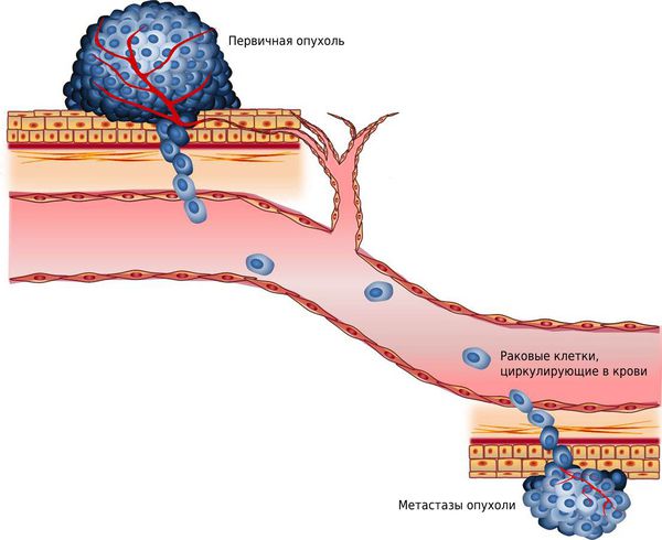 Что такое метастазы, их симптомы, признаки и лечение —