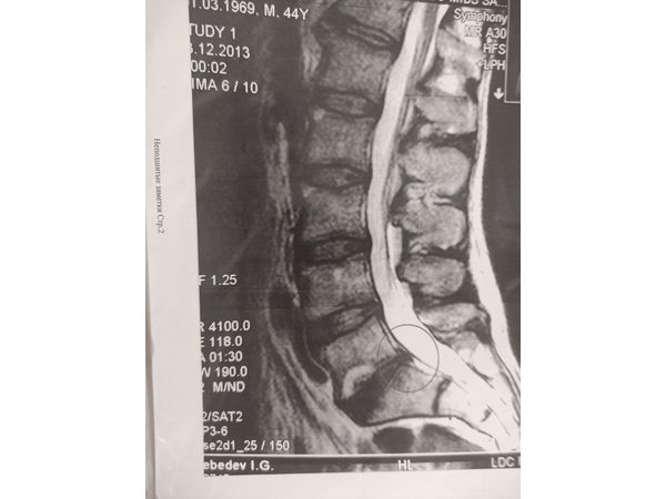 Снимок МРТ через 6 месяцев после лечения