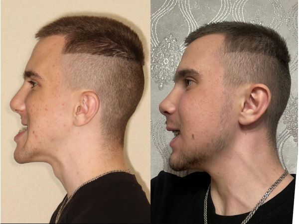 До и после операции: изменения в профиль