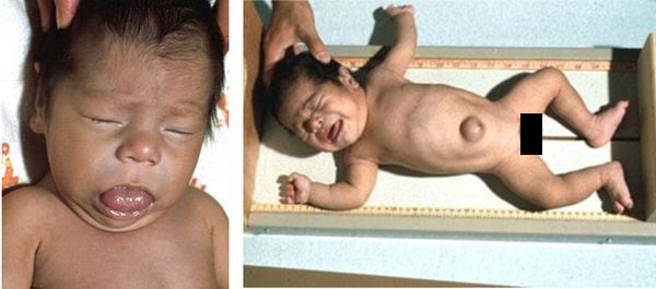 Младенец с врождённым гипотиреозом до начала лечения 