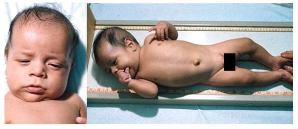 Младенец с врождённым гипотиреозом после начала лечения 