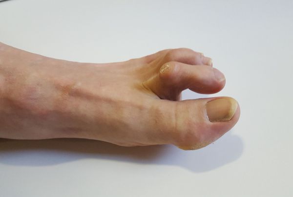 Молоточкообразная деформация пальцев стопы 