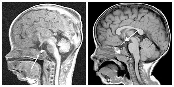 МРТ-снимки новорождённых: слева гипофиз здорового ребёнка, справа — ребёнка с дефицитом гормона роста