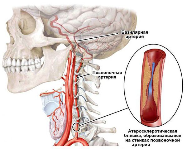 Нарушение кровообращения в позвоночных и базилярной артериях